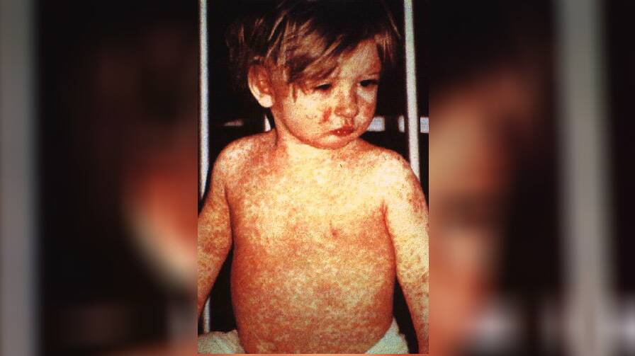 A child with a bad case of measles. Photo: Supplied