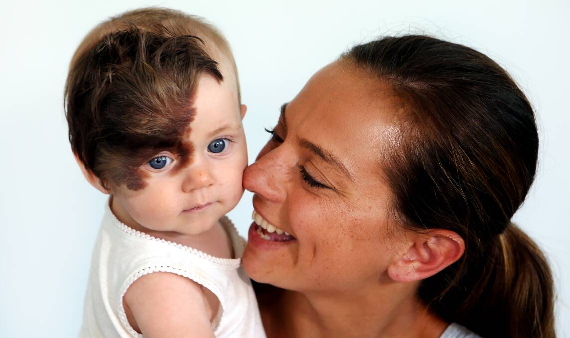 Rare condition: Towradgi girl Ruby Ashby, with mother Natalie, will have a series of operations to remove a mole on her face. Pictures: Sylvia Liber