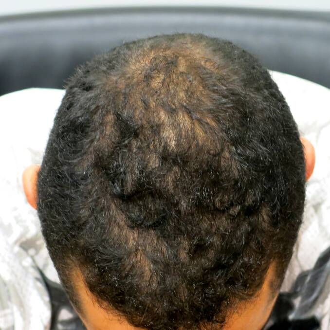 Before: Note that the hair is already thinning in this young man. It is essential to get in as early as possible with appropriate medically proven treatment.