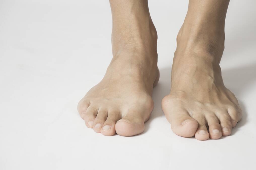 Bunion trouble: Don't put up with the pain and inconvenience, as this can be alleviated plus many other foot problems too at the Seaview Clinic in Wollongong.