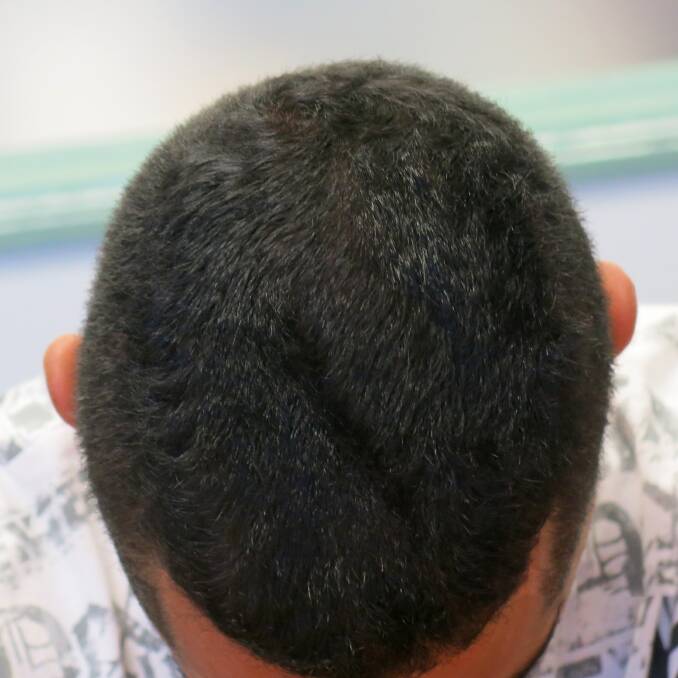 After treatment: Make sure your hair loss disorder is diagnosed correctly, as different hair loss disorders respond differently to different medications.