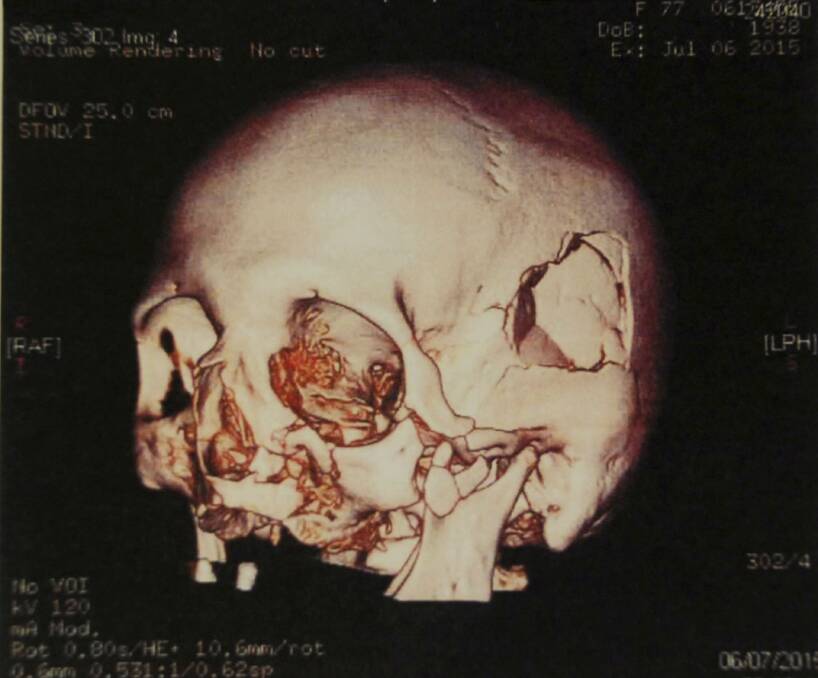A CT scan shows the victim's head injuries following the violent assault. Doctors said the woman's skull was 'caved in' and she had a smashed jaw and cheek bone. Picture: Supplied