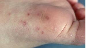 What you need to know about hand, foot and mouth disease