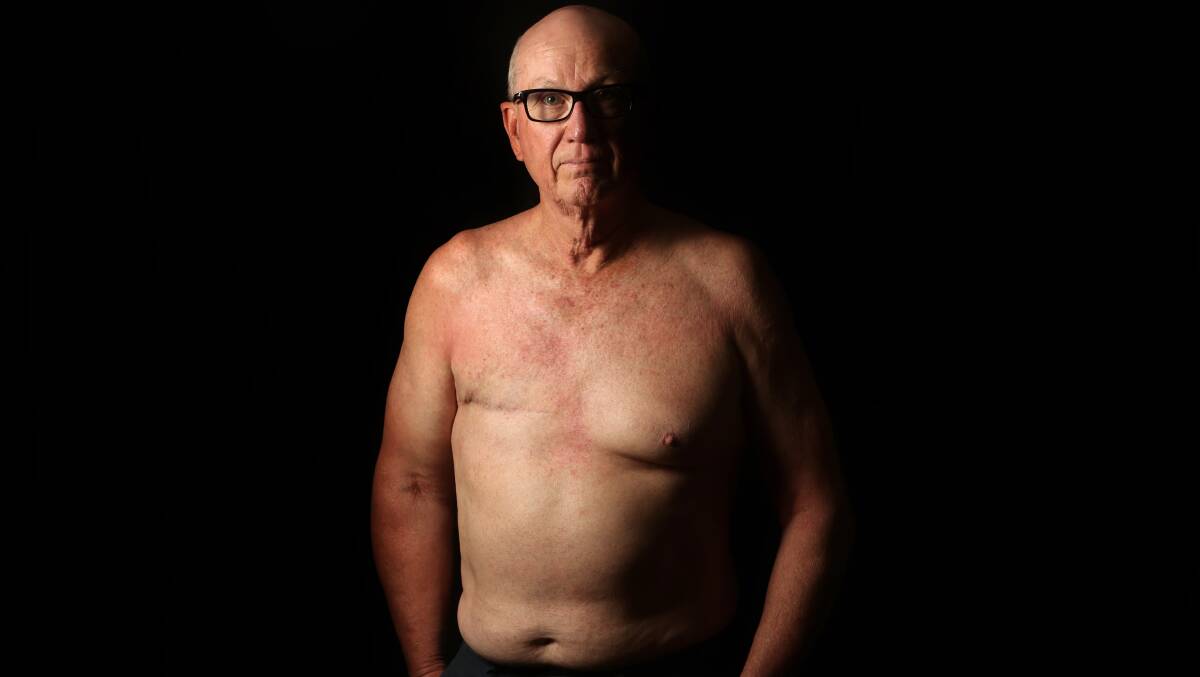 Raising awareness: It took Rob Fincher some time to deal with a breast cancer diagnosis, and mastectomy, but now he's helping other men. Picture: Sylvia Liber