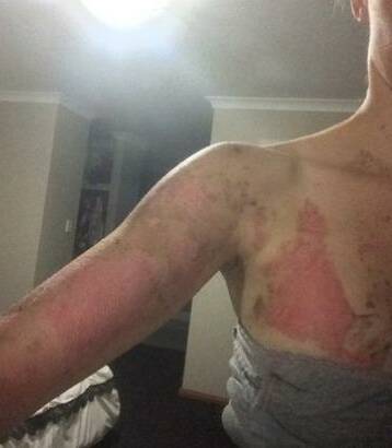Medical staff told Ms Jones she was not the first patient to present with burn injuries from a Thermomix incident.  Photo: Supplied