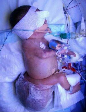 Aleyathiah Wilcockson was born weighing 900 grams with a 1.2-kilogram tumour below her tailbone Photo: Supplied
