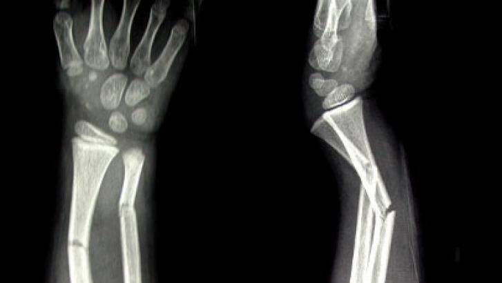 A new online tool will allow the public to assess their risk of fracture.  Photo: Supplied