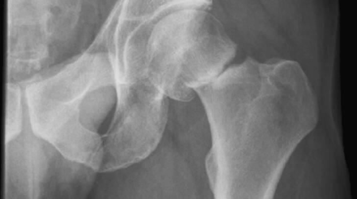 Hip fractures and other common breaks are predicted to increase with the ageing population.  Photo: Supplied