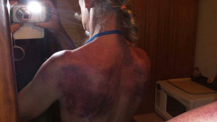 A follower shows bruising to his back as a result of slapping, or what Mr Xiao calls paida. Photo: Facebook