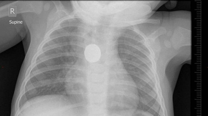 The x-ray showing a lithium button battery in Leo's oesophagus. Photo: Supplied