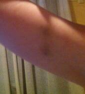 The bruise on Fraser's arm.