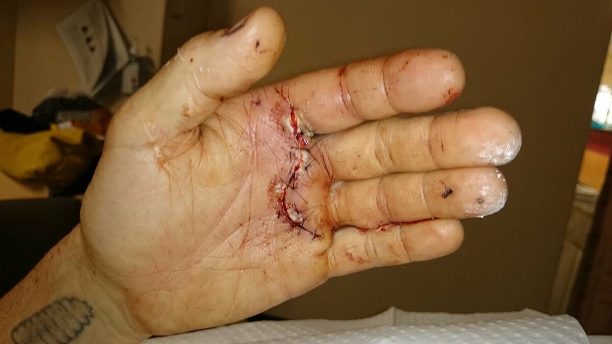 Trent Burton's hand after the crocodile attack. Picture: SOUTH COAST REGISTER