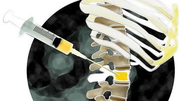 Researchers found treatment of central spinal stenosis in the lower back using epidural injections of steroids plus anaesthetic offered minimal or no short-term benefit as compared with anaesthetic alone. Illustration: Karl Hilzinger