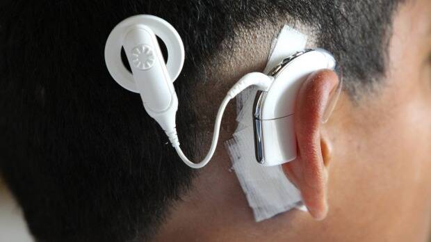 A Cochlear ear device. Picture: PETER RAE.
