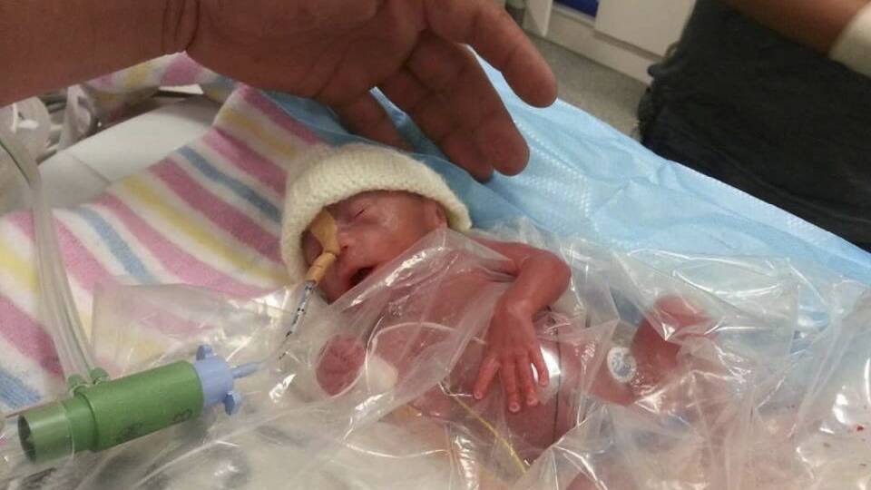 Baby Michael, born at 24 weeks’ gestation.