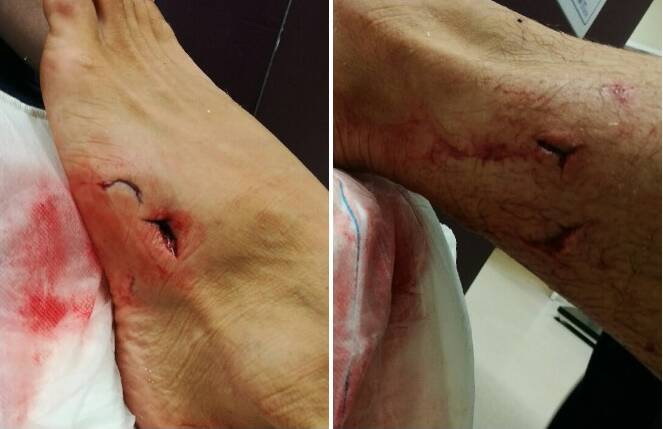 Adam Hoare suffered five puncture wounds, two on his left foot and three on his lower left leg, after being hit by a shark at Kiama Surf beach. Pictures: Supplied