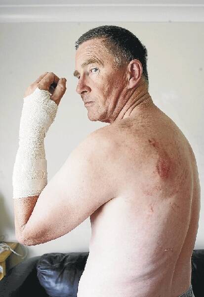 Mr Chalmers, a grandfather from Warilla, shows the bruises and wounds inflicted.