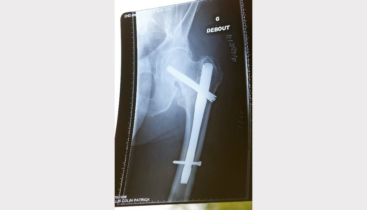 An X-ray shows the pins that were inserted into Mr Hollis’ left thigh.