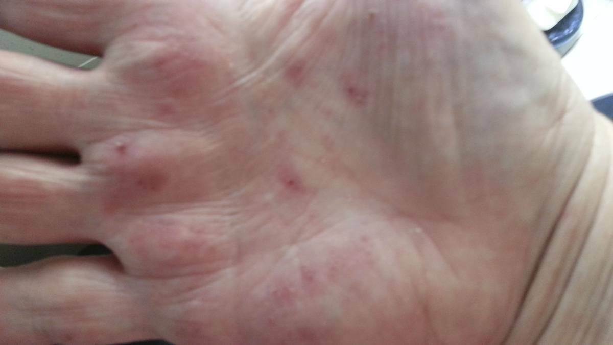 Earlier this week a Wollongong woman claimed this rash was caused by harbour sewage.