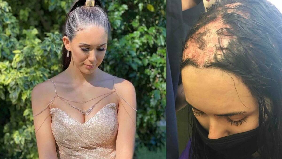 Eve, 19, has shared her experience with alopecia, psoriasis and other conditions. Pictures: supplied.