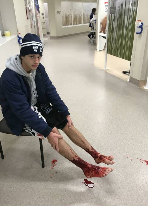 Bloody mess: Sam Kanizay in Emergency at Sandringham hospital on Saturday night, his lower legs bloody after bathing n the bay at Brighton.  Photo: Jarrod Kanizay