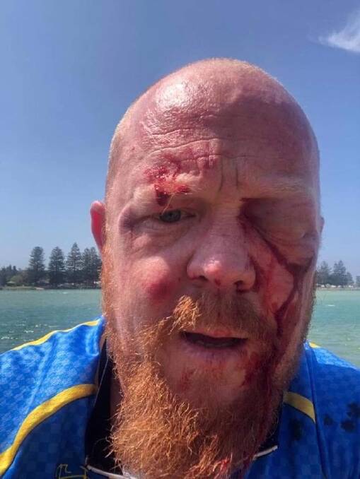 Bashed: Off-duty paramedic Dan Mansbridge assaulted at Windang on Friday. Picture: Facebook 