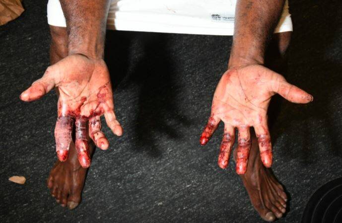 Petero Baleinapuka's injured hands. Picture: Supplied