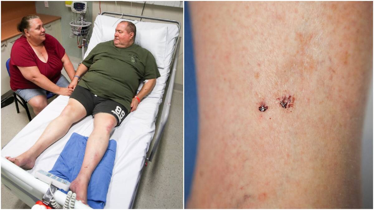 Bryan Thompson was left with two puncture marks on his ankle after he was bitten by a suspected red-bellied black snake. He spent the night in hospital supported by his wife Lisa. Pictures: Adam McLean