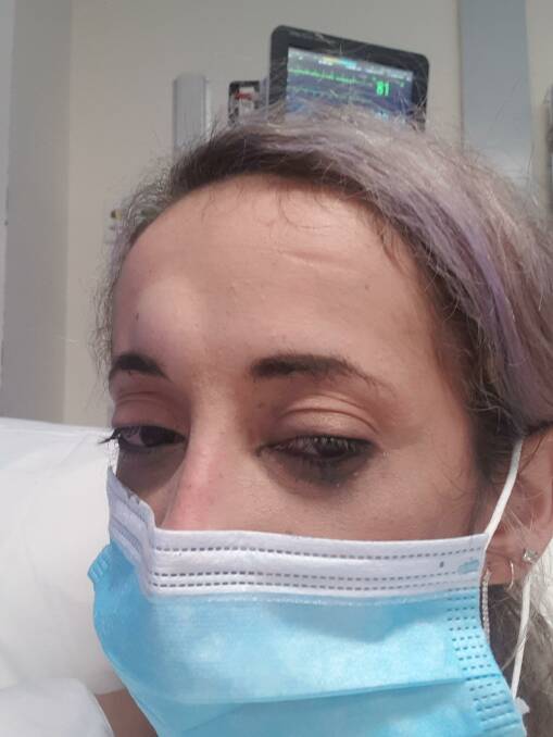 Sarah Smith attended Wollongong Hospital with a head injury following an assault at Pepe's bar. Picture: Supplied