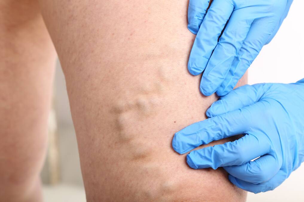 Women are more affected by varicose veins: Fluctuations in hormones can worsen problem veins but Dr Bullen from the Vascular Care Centre uses micro surgery to fix the problem.
