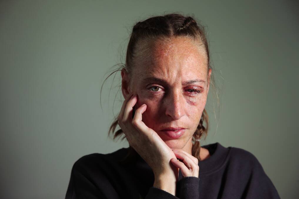 October 6: Carissa Edwards was left traumatised and blinded in one eye after she was coward punched and knocked unconscious at a children's birthday party. 