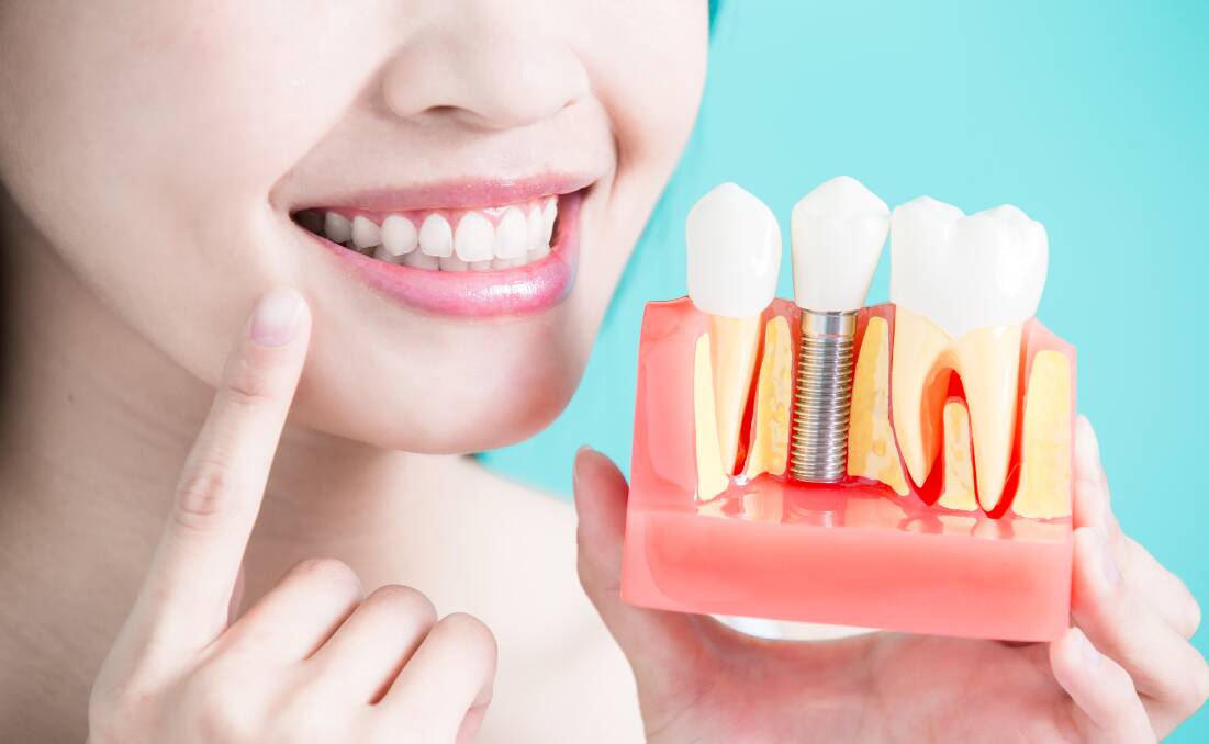 Beautiful Smiles communicate us thru why dental implants are so widespread | Illawarra Mercury