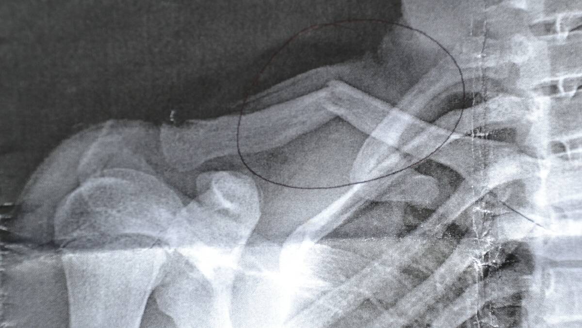 The X-ray showing the teenager's broke collarbone.
