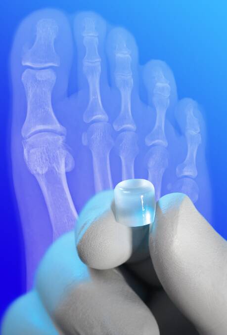New treatment: Cartiva is a synthetic cartilage substitute that is effective in alleviating pain while maintaining motion in patients with foot arthritis.