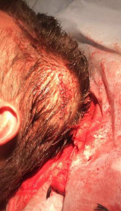 Wollongong one-hit victim required nine staples