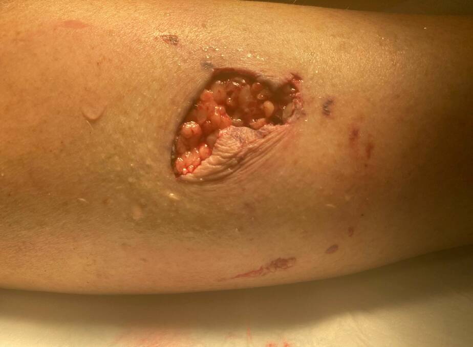 The wound to Ms Taafe's leg required plastic surgery and weeks of dressing changes and treatment to guard against the risk of infection. Picture: supplied 