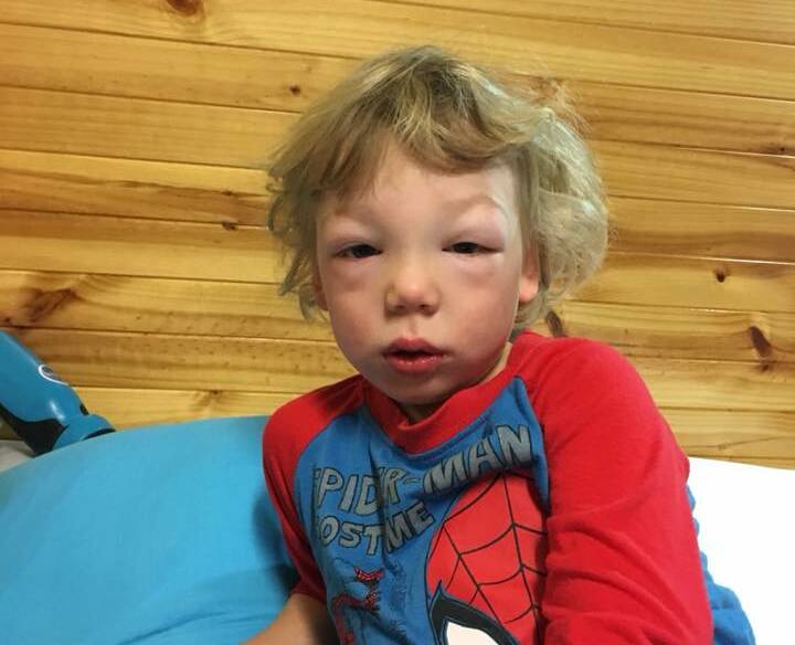 PUFFY: Isaac's condition caused his face to swell beyond recognition during a family getaway earlier this year. Picture: Facebook