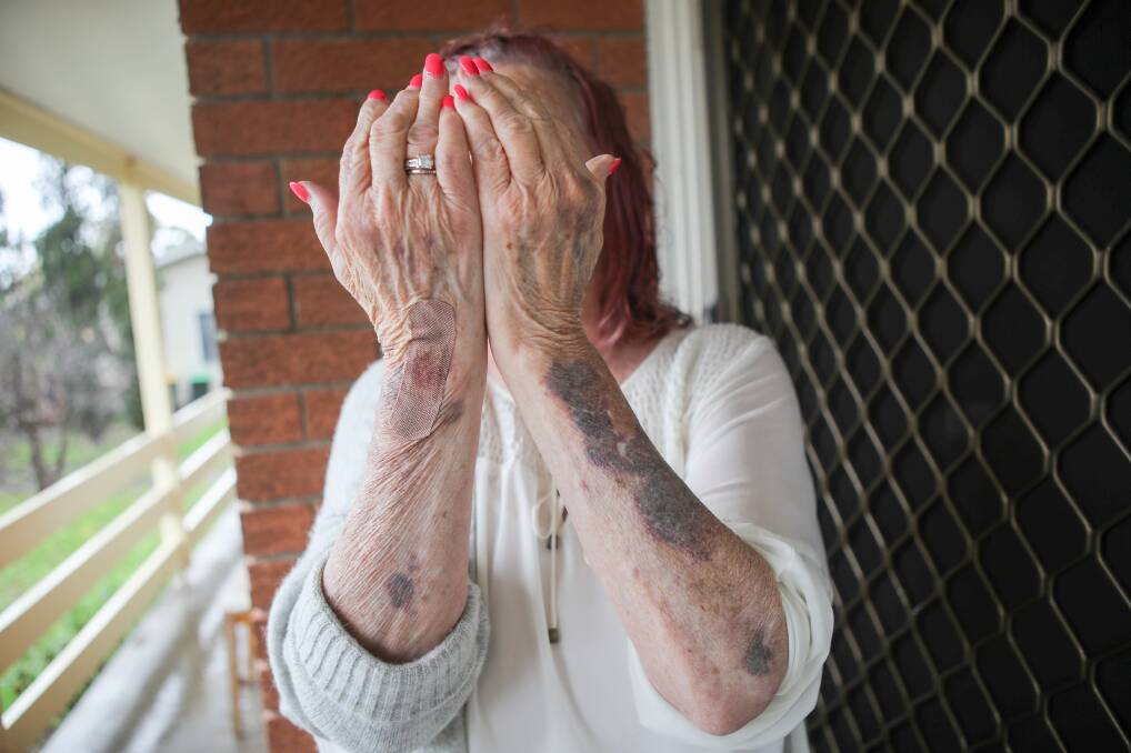 Sue Wheeler displays her badly bruised arms. Picture: Adam McLean 