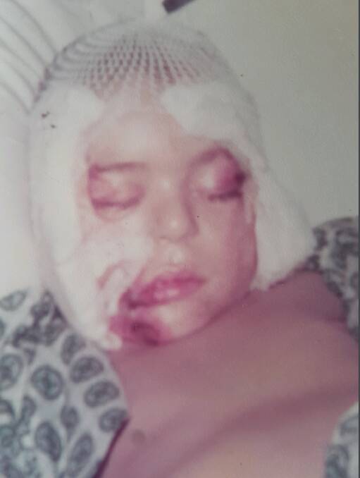 The seven-year-old's parents feared he would lose the use of his right eye due to the damage caused by the accident. Picture: supplied 