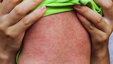 Health authorities issue measles alert for the Illawarra