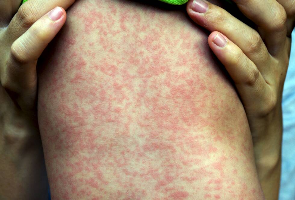 Look out for measles symptoms including a red, spotty, non-itchy rash which usually starts on the head and neck and moves down onto the trunk and limbs.