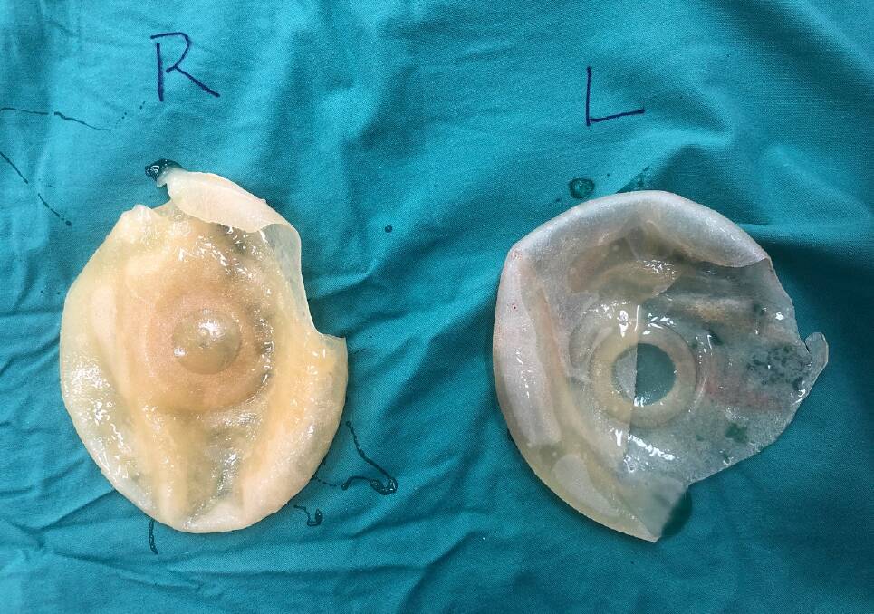 Excised: Ruptured implants which were removed by surgeon Professor Anand Deva from a patient last week. He's researching what goes wrong. Picture: Supplied