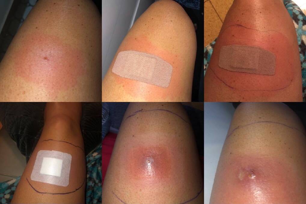 Blood infection: The bite site turned from bad to worse over the course of a week, as sepsis set in, causing the skin to blister, redden and swell. Pictures: Supplied