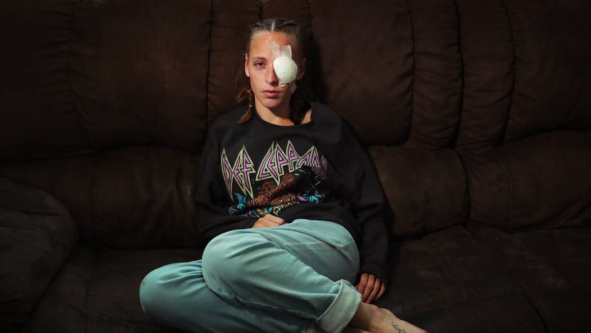 Dapto mum Carissa Edwards pictured with a patched eye after she was left with serious injuries on September 17. Picture by Sylvia Liber