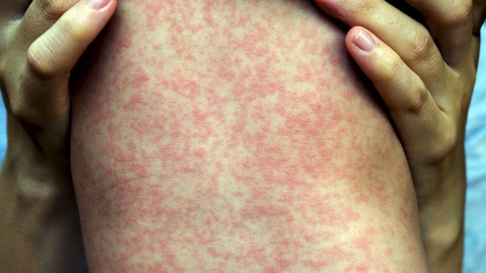 Measles alert for travellers at Sydney's domestic and international airport