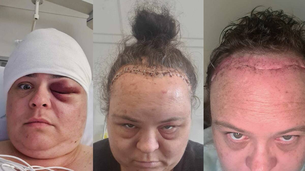Pictures show the scars along Lisa's hairline from two surgeries.