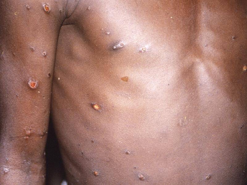 Spain is reporting 30 total cases of monkeypox, as the disease slowly spreads in Europe.