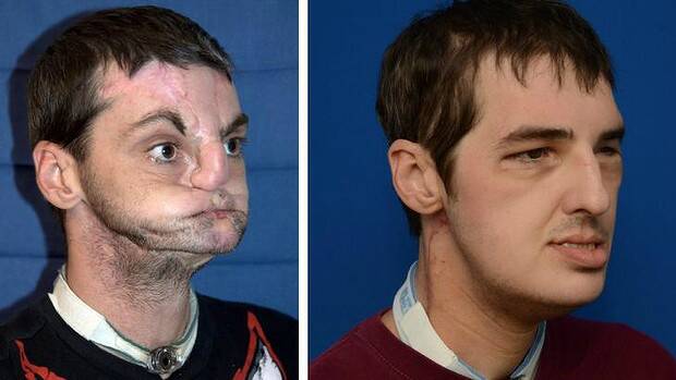 Richard Norris before and after the transplant surgery. Photo: AP