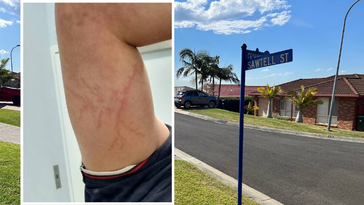 The telltale "fern" burn marks of a lightning strike left on Darren McBrides's left arm after he was stuck by lightning at his Sawtell Street home in Albion Park. Picture (inset) supplied, Nadine Morton