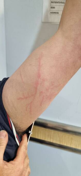 The telltale "fern" burn marks of a lightning strike on Darren McBride's arm. Picture supplied